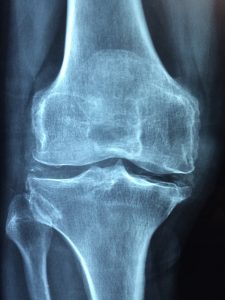 Artrose no Joelho: Como a Fisioterapia Domiciliar Pode Aliviar seus Sintomas