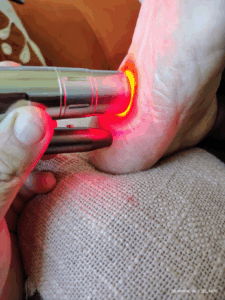 Fisioterapia para fascite plantar com atendimento domiciliar